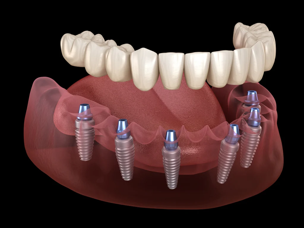 Full Mouth Dental Implants