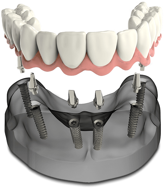 acrylic overdenture – removable and fixed