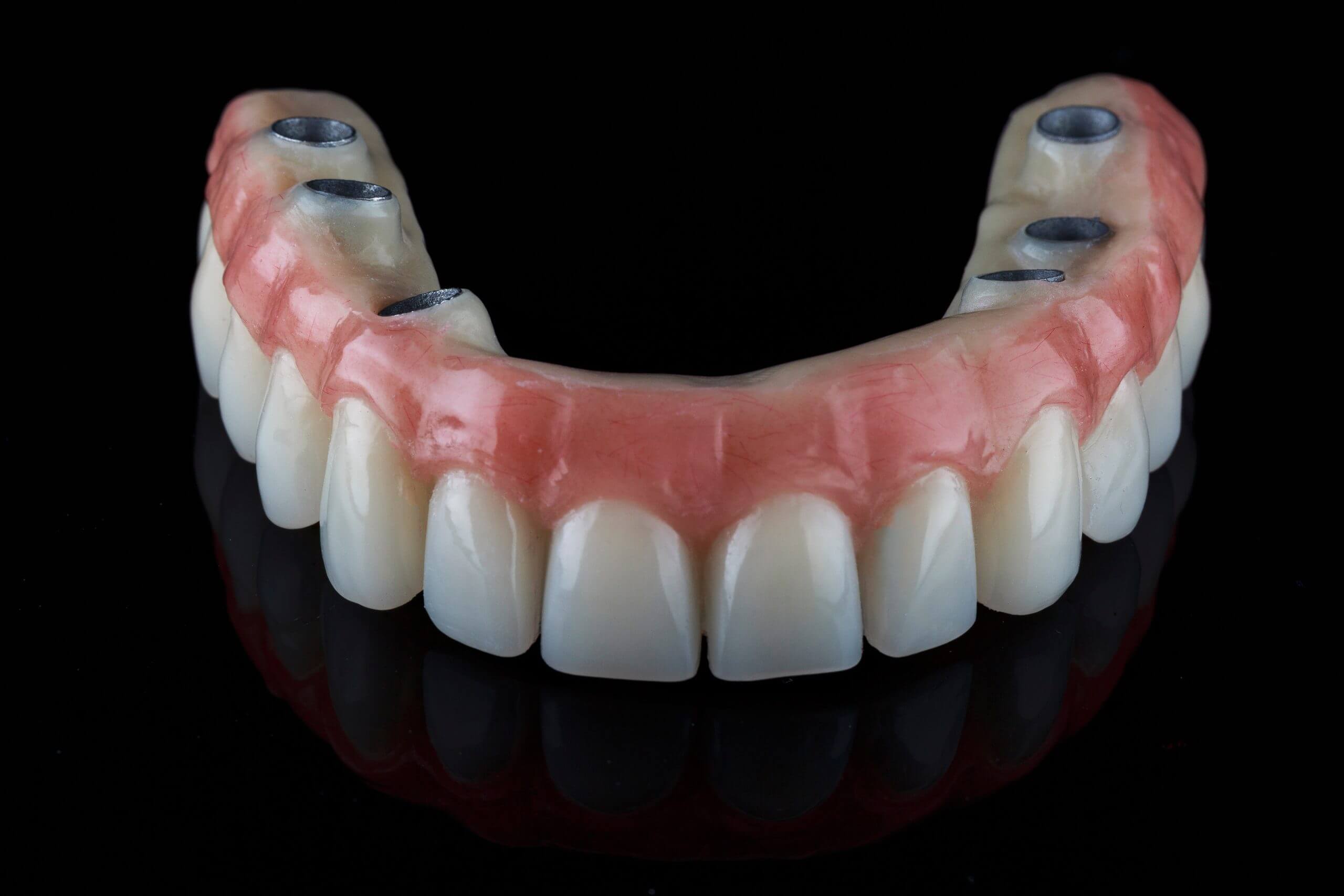 full arch of missing teeth