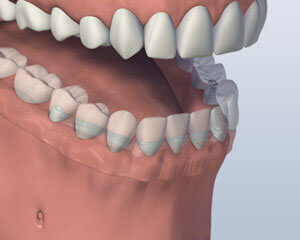mouth with bar attachment denture